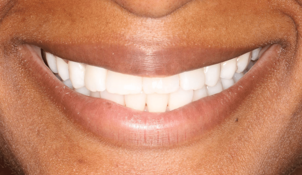 After - Fleckney Dental & Cosmetic Clinic