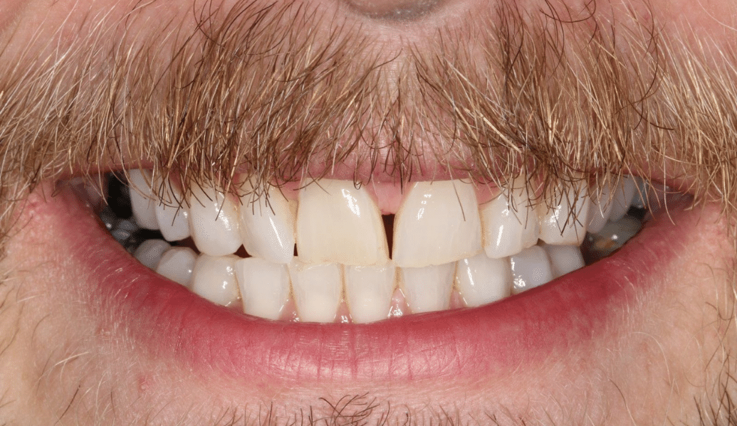 After - Fleckney Dental & Cosmetic Clinic