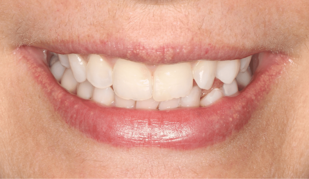 After - Fleckney Dental & Cosmetic Clinic