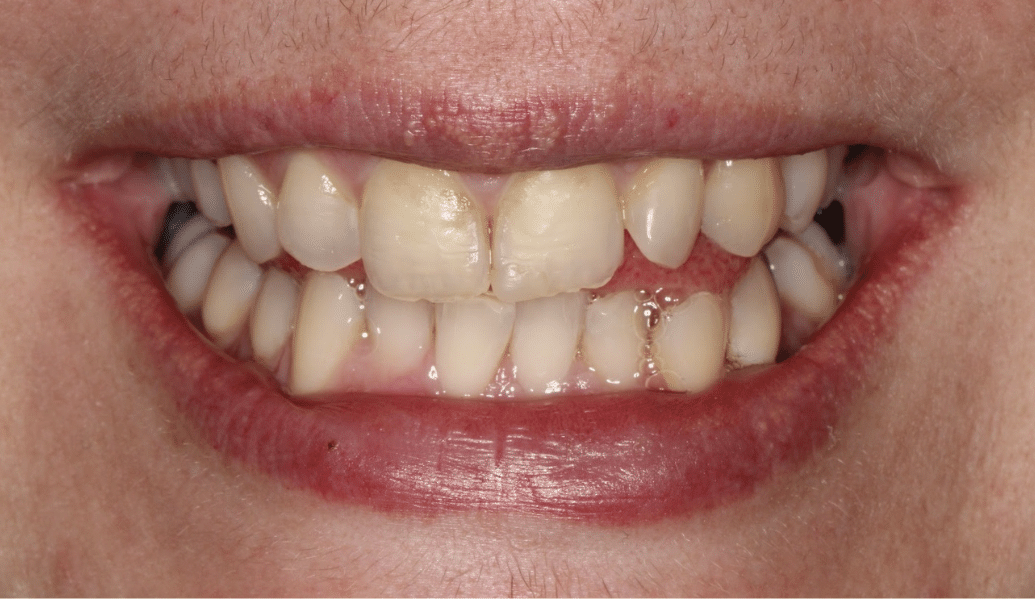 Before - Fleckney Dental & Cosmetic Clinic