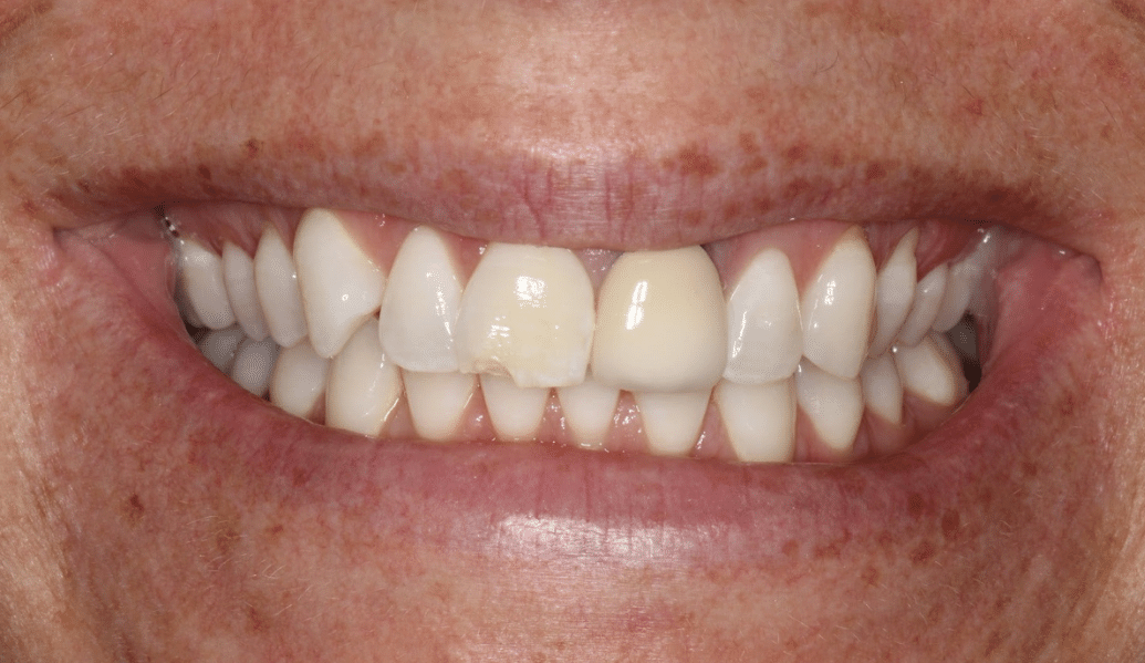 After - Fleckney Dental & Cosmetic Clinic