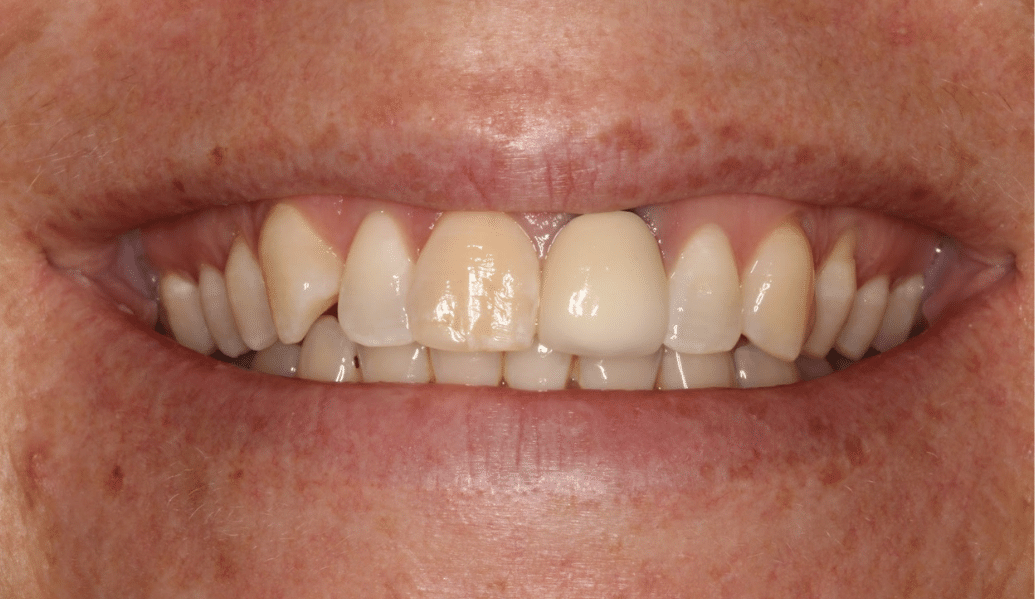 Before - Fleckney Dental & Cosmetic Clinic