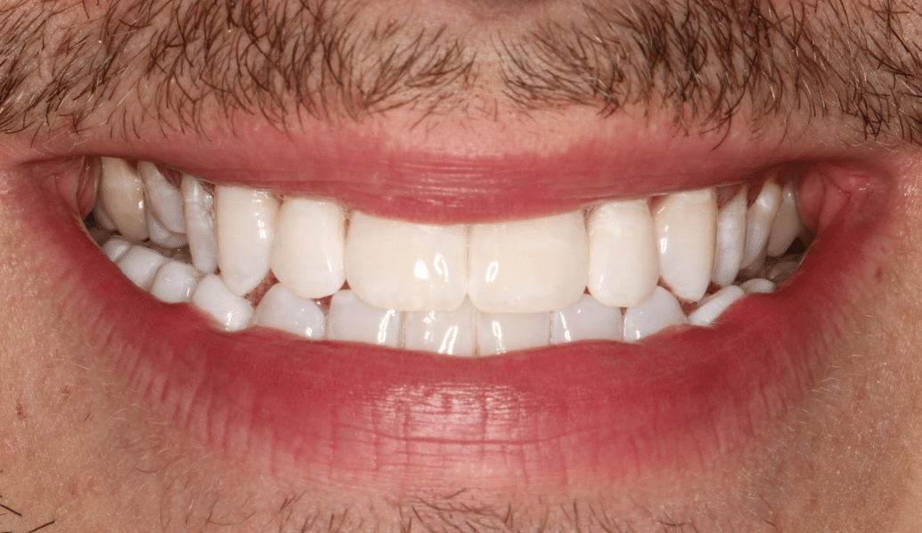 After - Fleckney Dental & Cosmetic Clinic