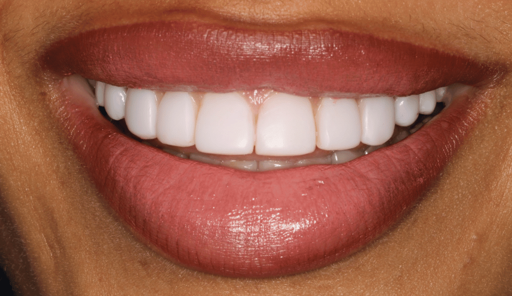 After - Fleckney Dental & Cosmetic Clinic