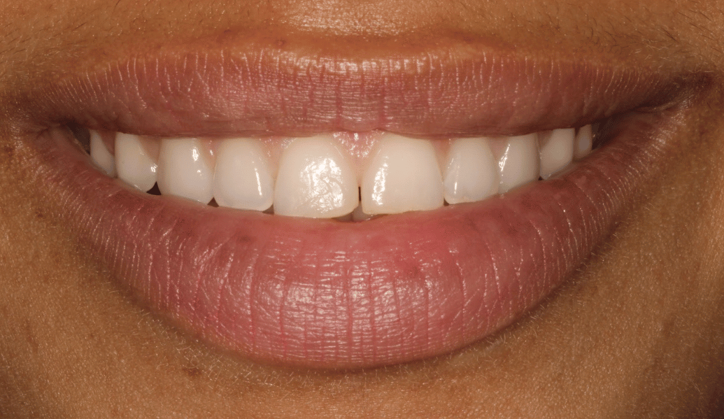 Before - Fleckney Dental & Cosmetic Clinic