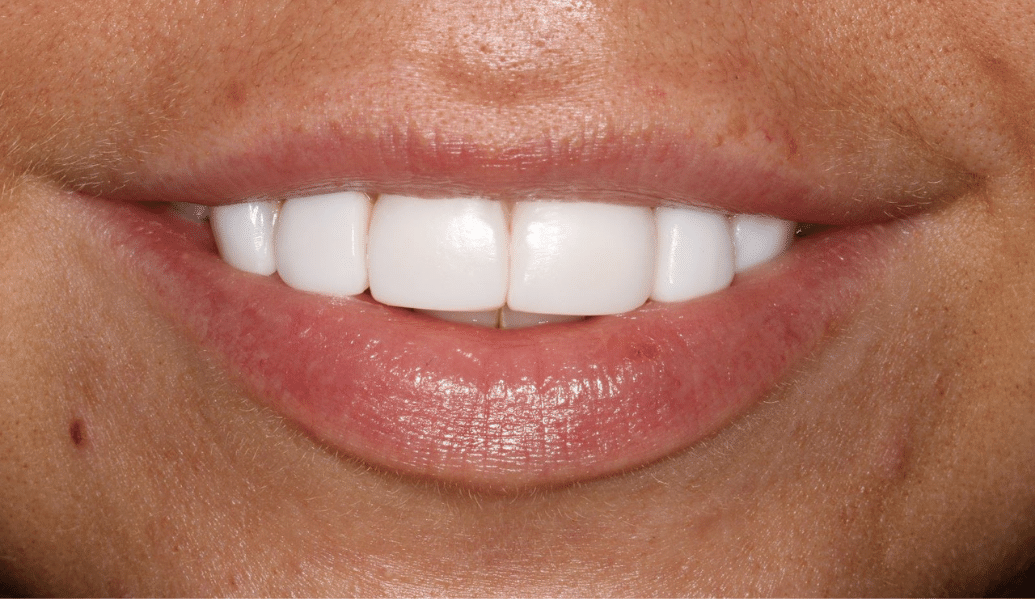 After - Fleckney Dental & Cosmetic Clinic