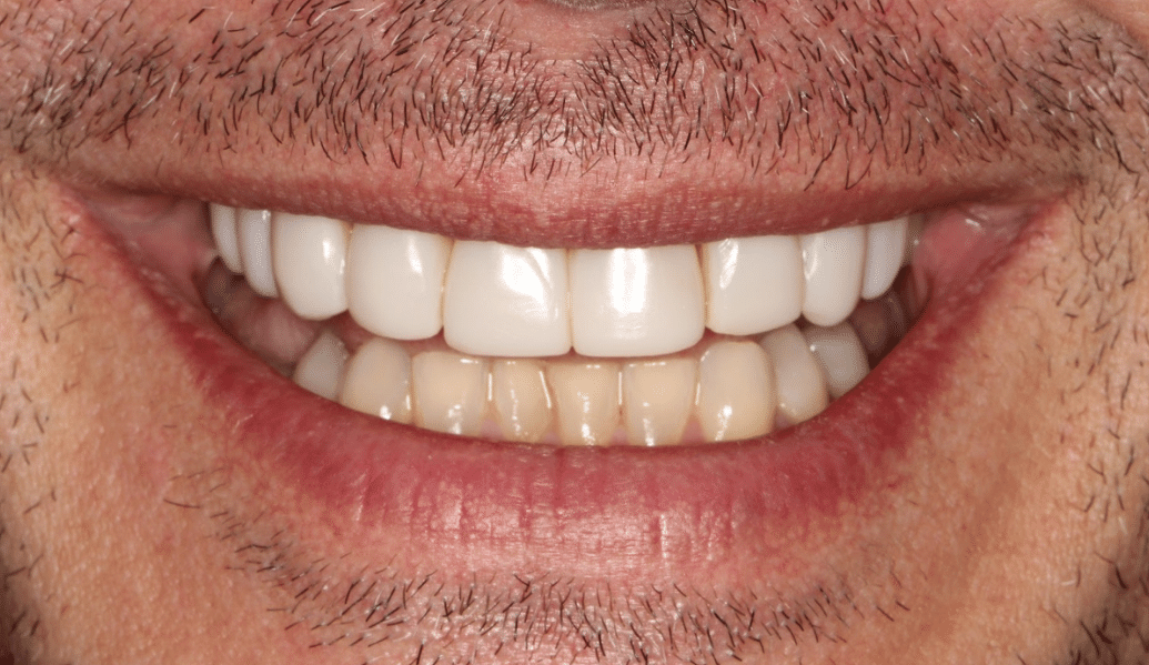 After - Fleckney Dental & Cosmetic Clinic