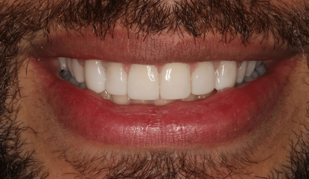 After - Fleckney Dental & Cosmetic Clinic