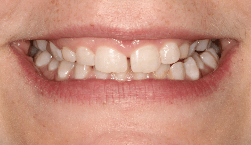 Before - Fleckney Dental & Cosmetic Clinic