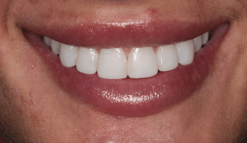 After - Fleckney Dental & Cosmetic Clinic