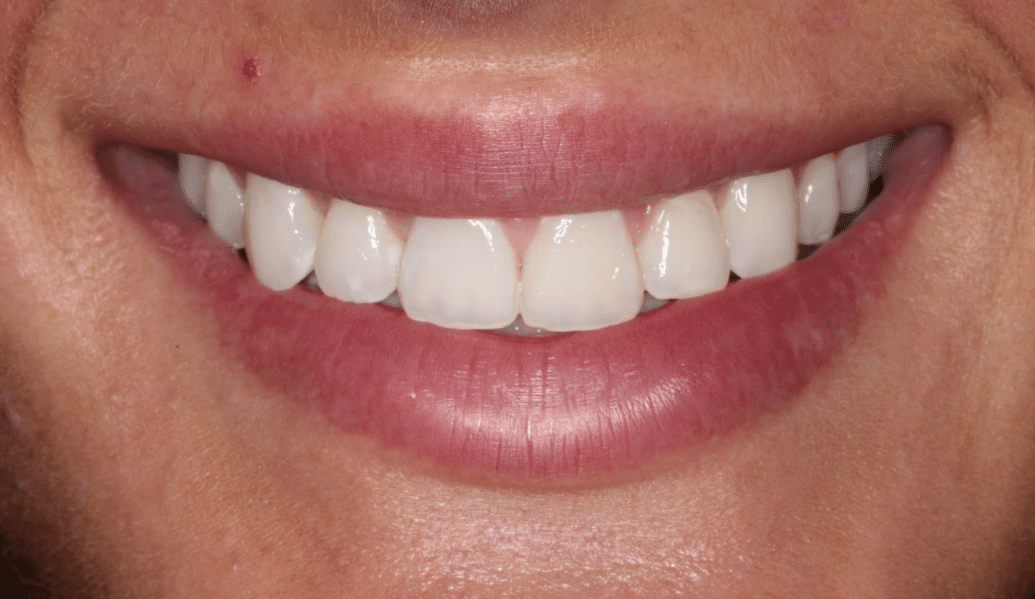 Before - Fleckney Dental & Cosmetic Clinic