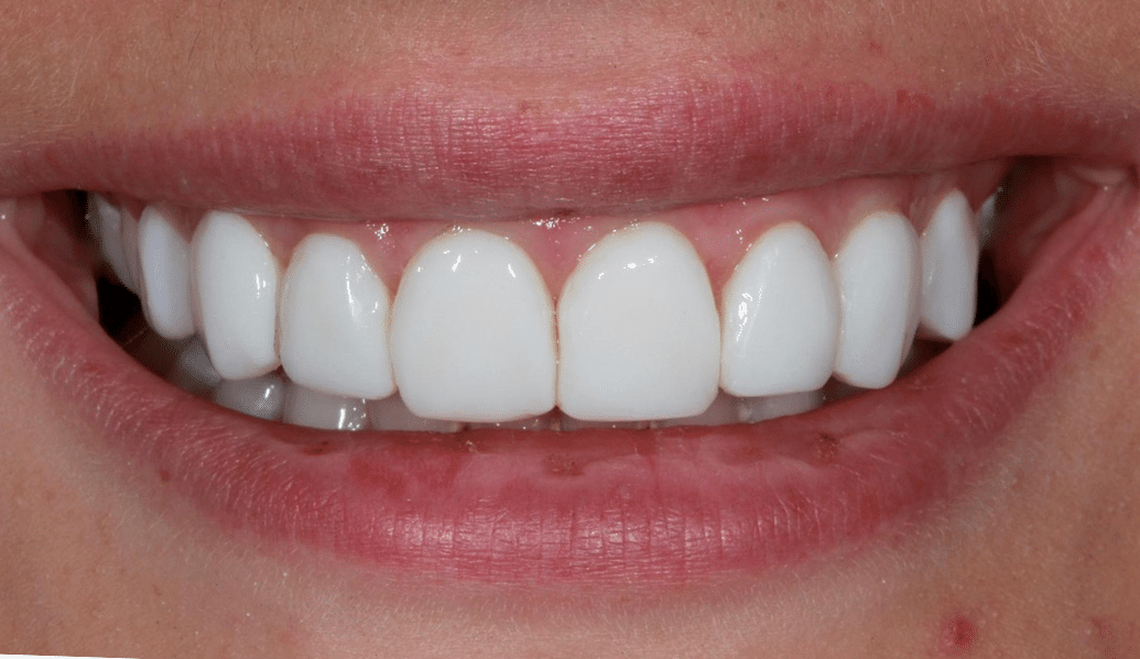 After - Fleckney Dental & Cosmetic Clinic