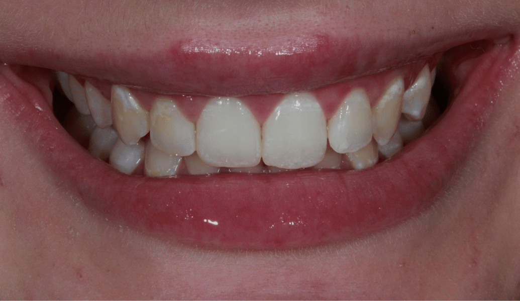Before - Fleckney Dental & Cosmetic Clinic