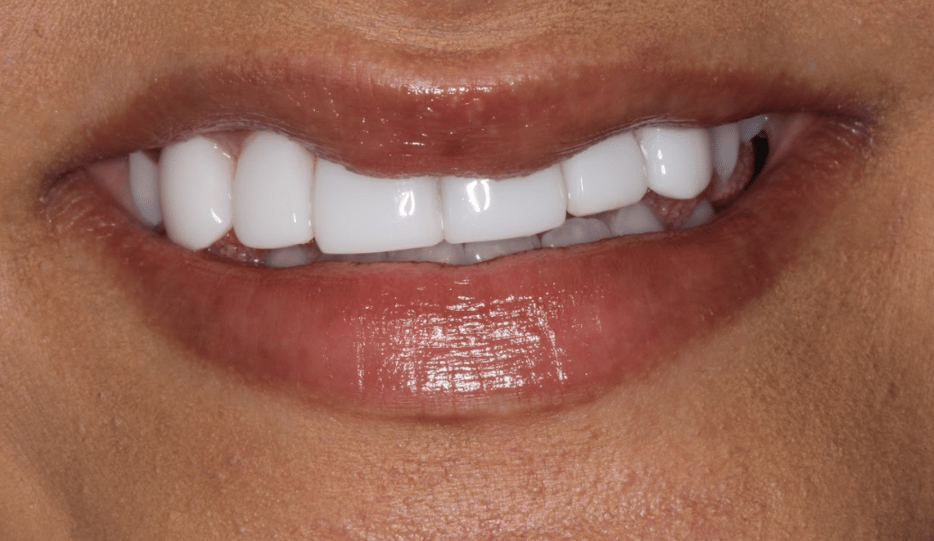 After - Fleckney Dental & Cosmetic Clinic