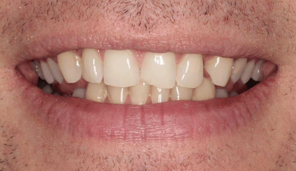 Before - Fleckney Dental & Cosmetic Clinic