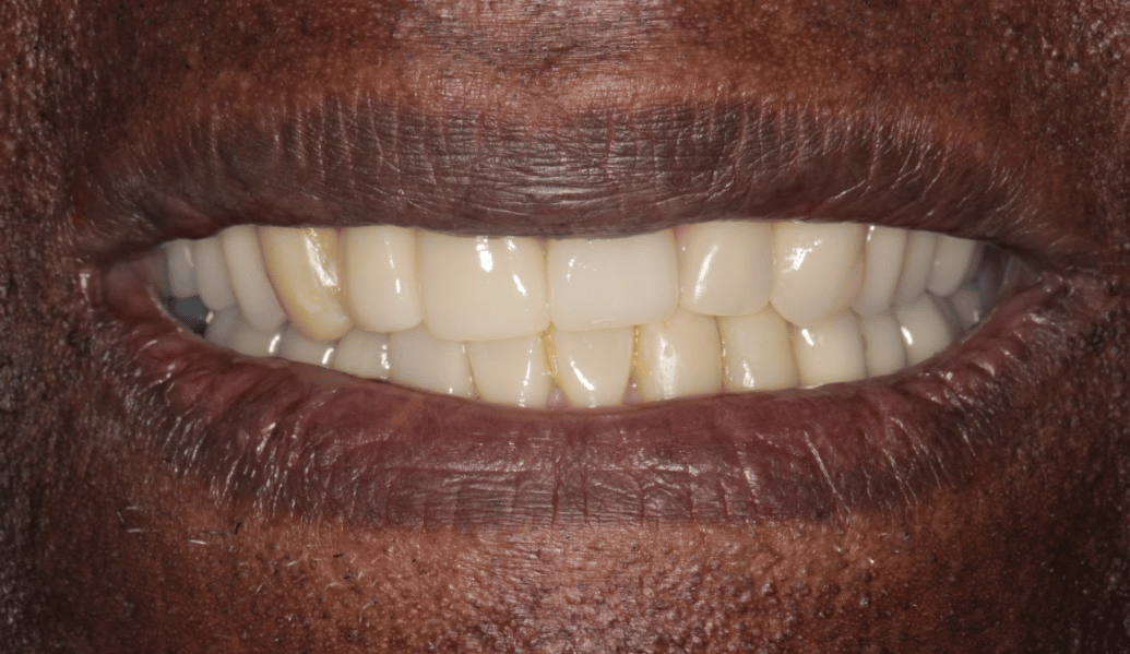 After - Fleckney Dental & Cosmetic Clinic