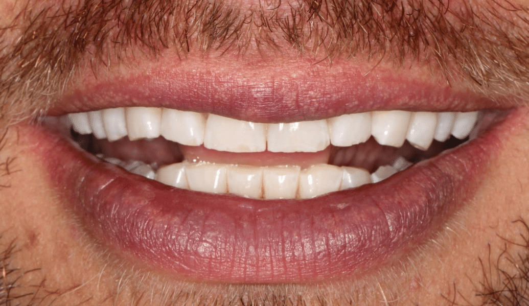 After - Fleckney Dental & Cosmetic Clinic