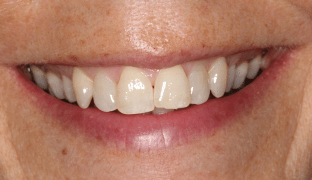 After - Fleckney Dental & Cosmetic Clinic