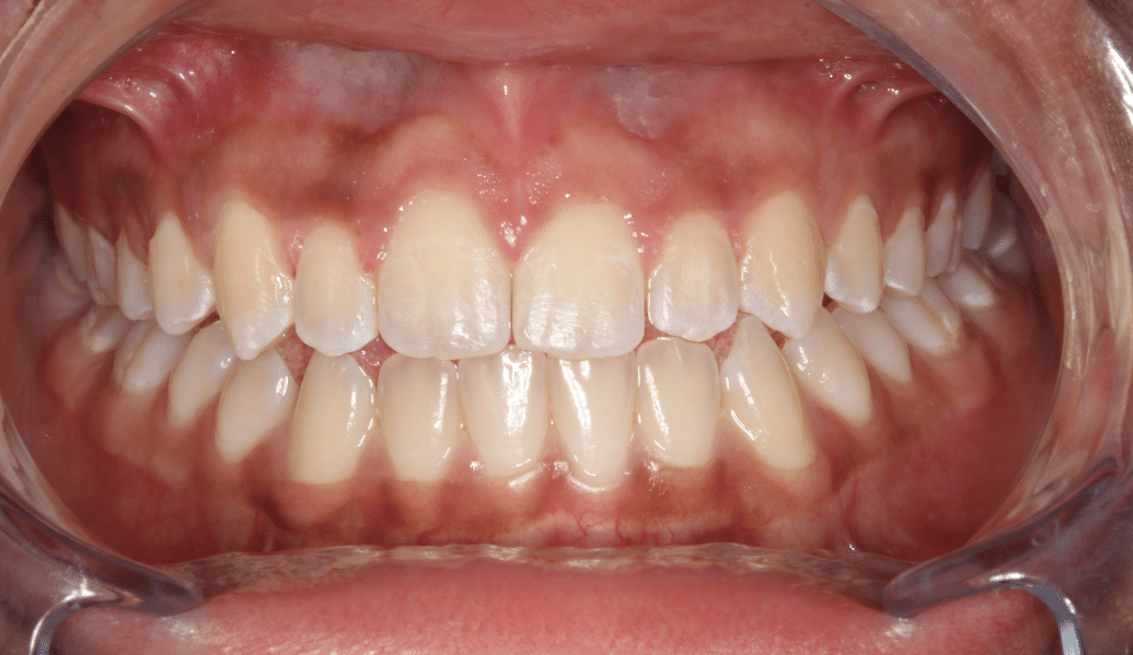 After - Fleckney Dental & Cosmetic Clinic