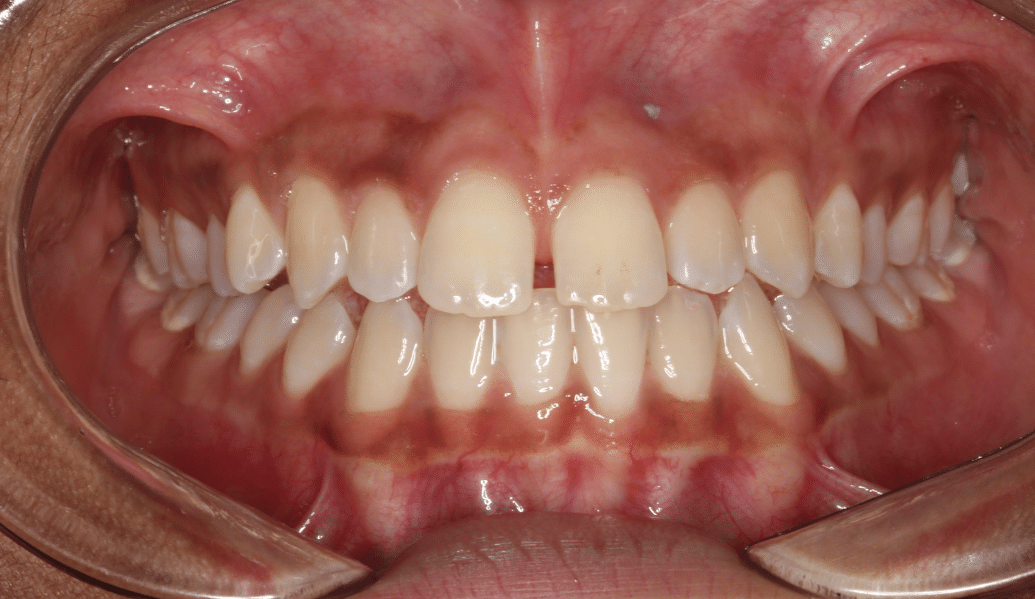 Before - Fleckney Dental & Cosmetic Clinic