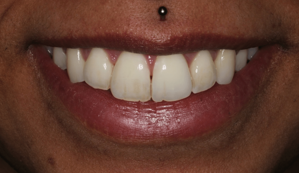 After - Fleckney Dental & Cosmetic Clinic