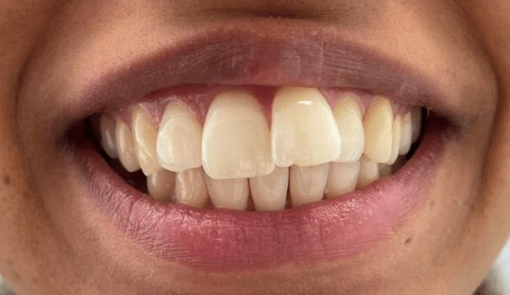 Before - Fleckney Dental & Cosmetic Clinic