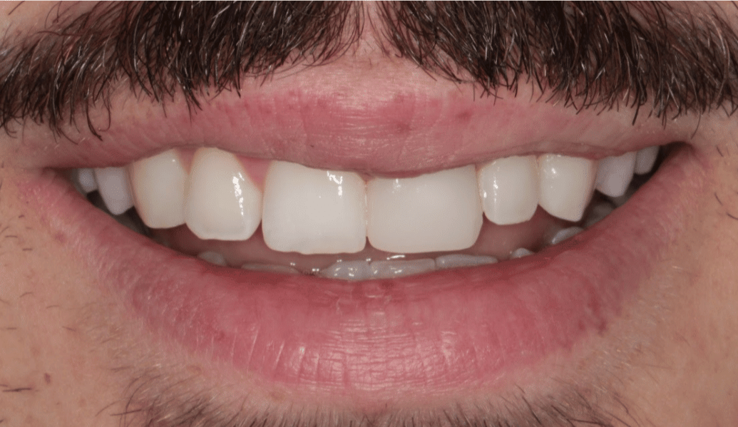 After - Fleckney Dental & Cosmetic Clinic