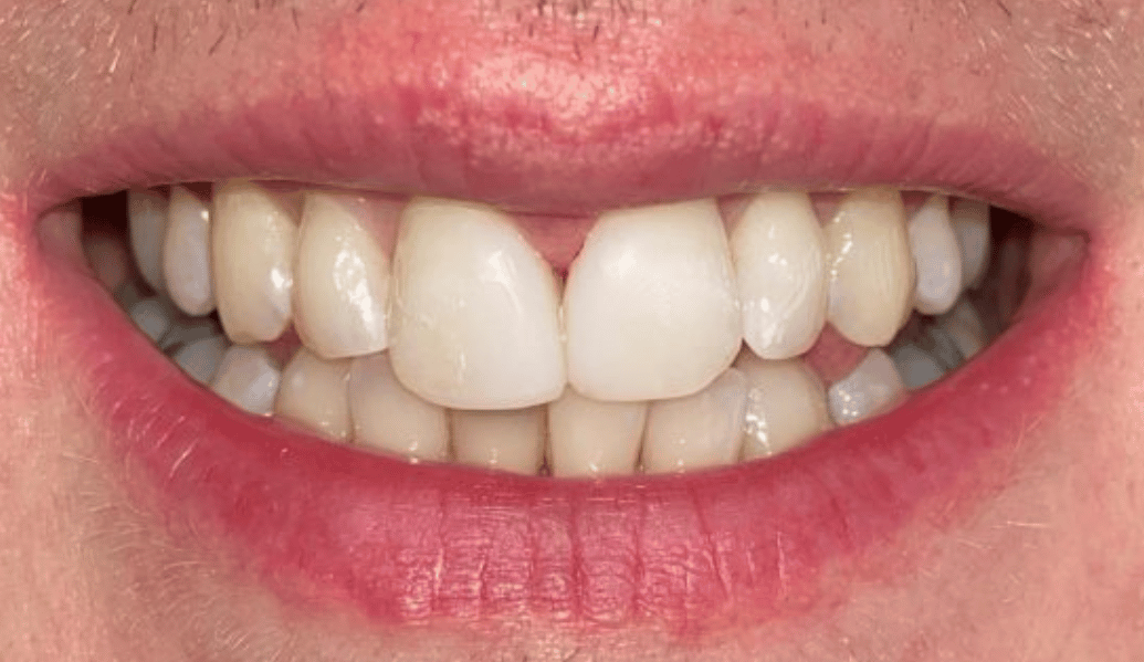 After - Fleckney Dental & Cosmetic Clinic