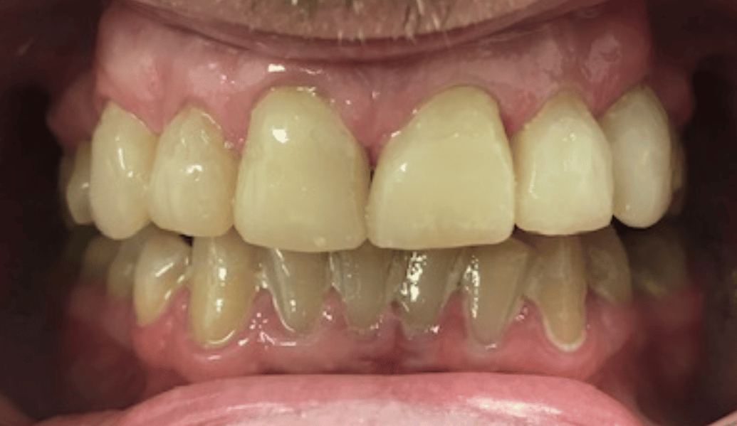 After - Fleckney Dental & Cosmetic Clinic