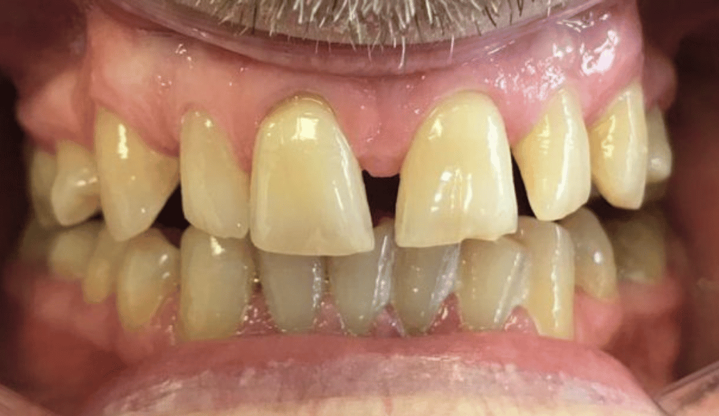 Before - Fleckney Dental & Cosmetic Clinic