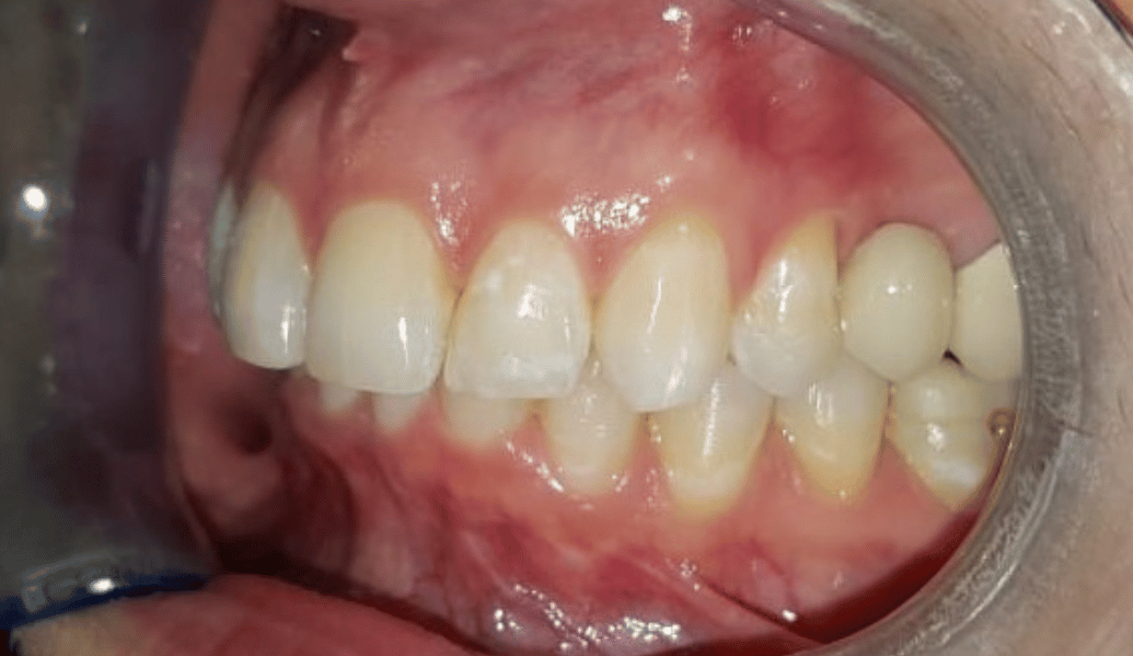 After - Fleckney Dental & Cosmetic Clinic