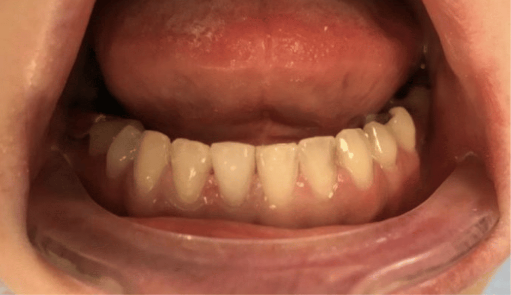 After - Fleckney Dental & Cosmetic Clinic