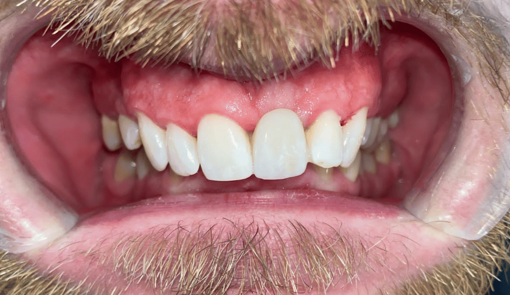 After - Fleckney Dental & Cosmetic Clinic