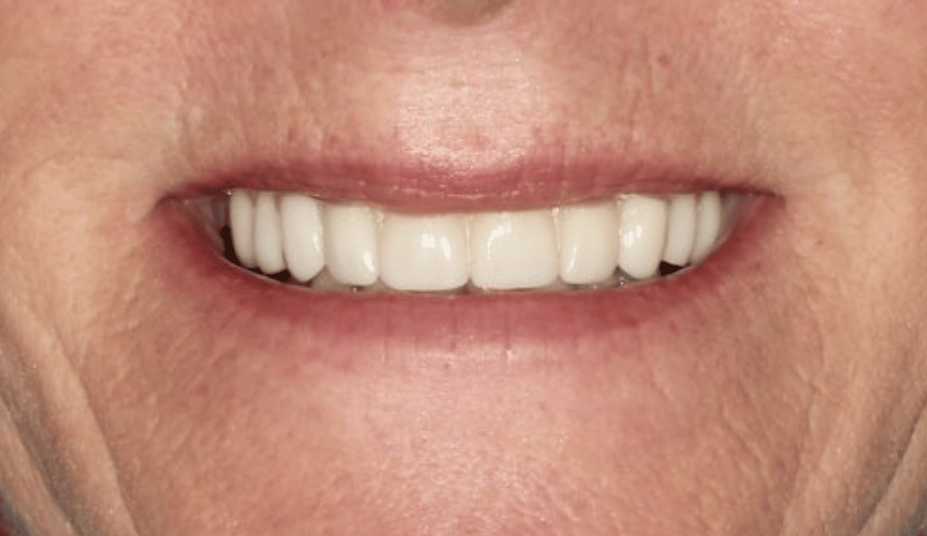 After - Fleckney Dental & Cosmetic Clinic