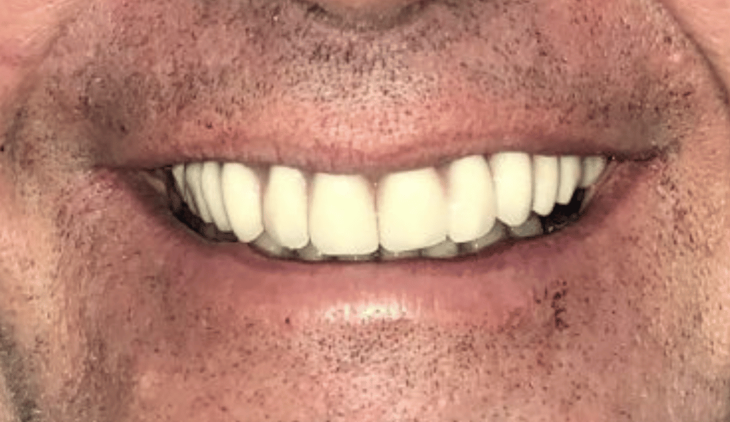 After - Fleckney Dental & Cosmetic Clinic