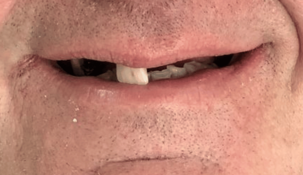 Before - Fleckney Dental & Cosmetic Clinic