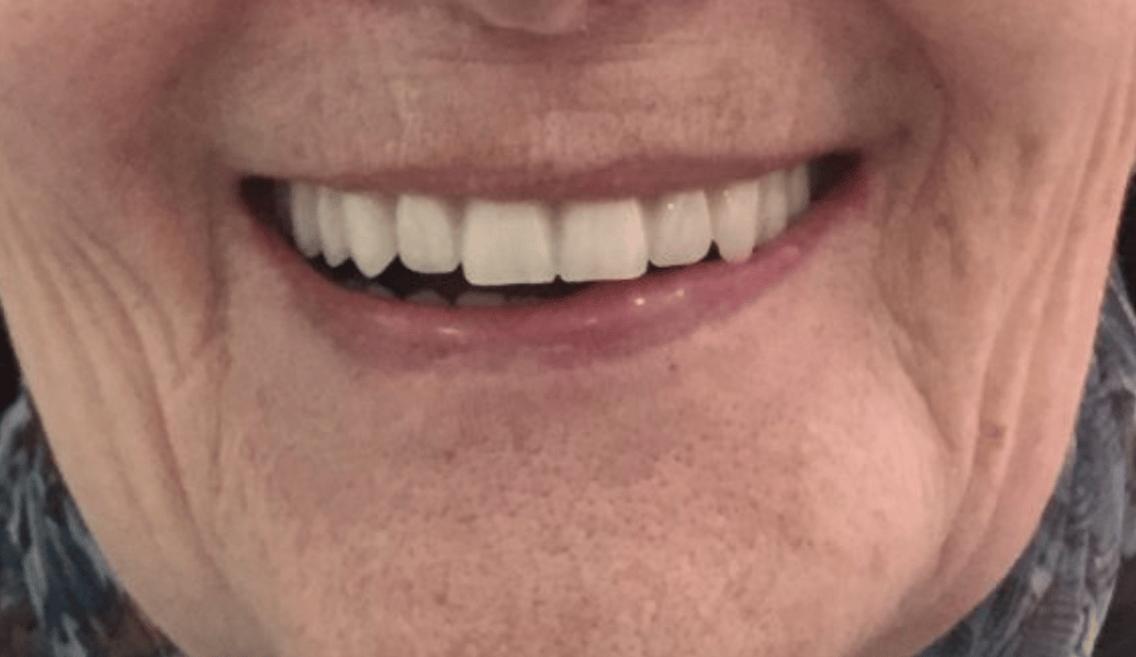 After - Fleckney Dental & Cosmetic Clinic