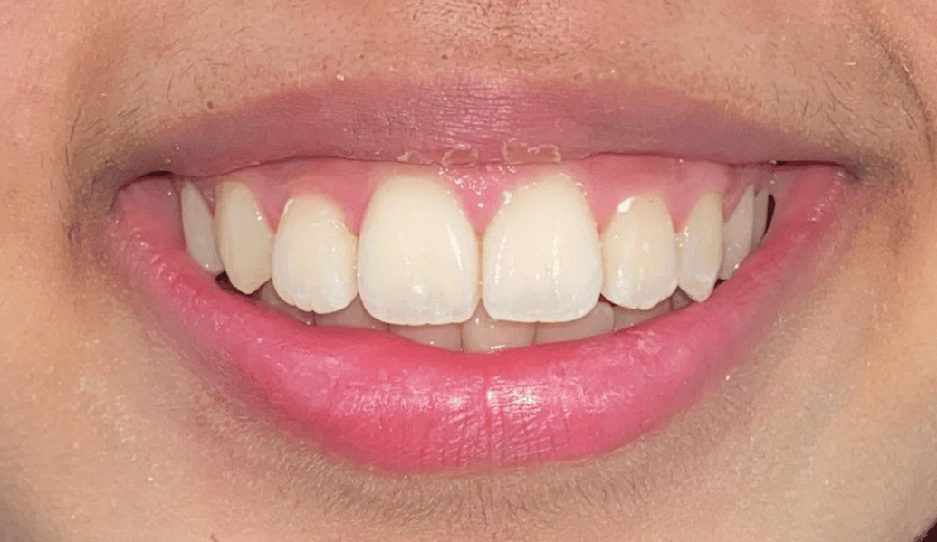 After - Fleckney Dental & Cosmetic Clinic