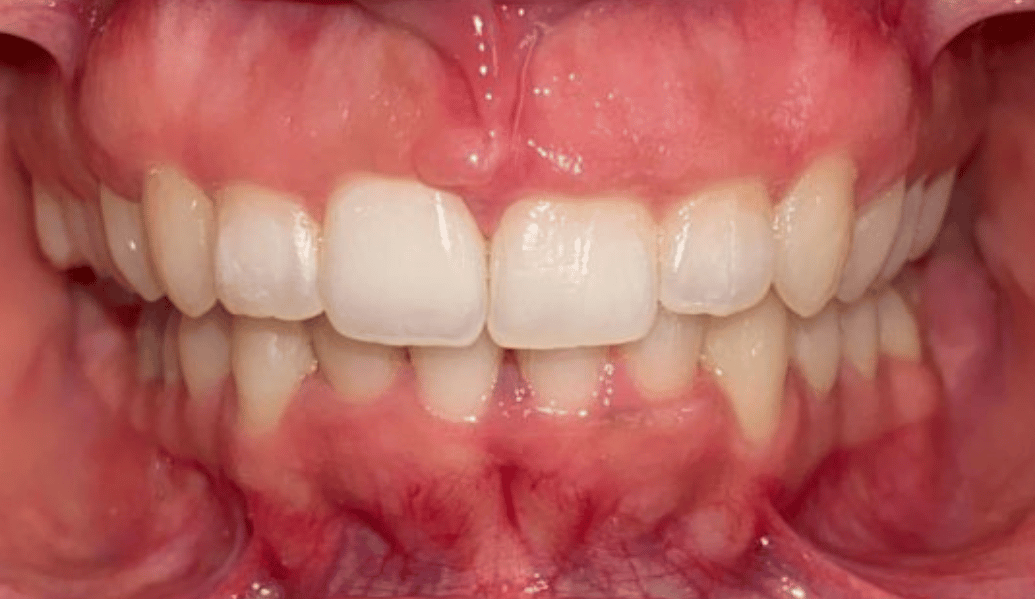 After - Fleckney Dental & Cosmetic Clinic