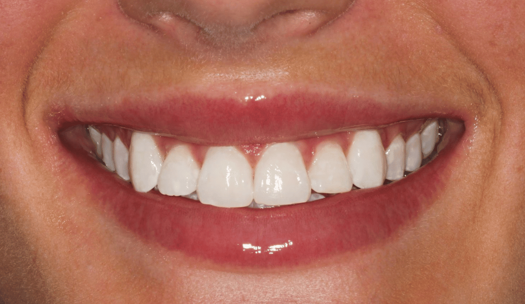 After - Fleckney Dental & Cosmetic Clinic