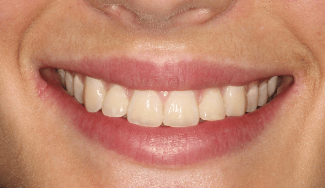 Before - Fleckney Dental & Cosmetic Clinic