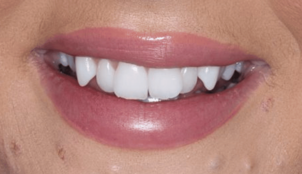 After - Fleckney Dental & Cosmetic Clinic