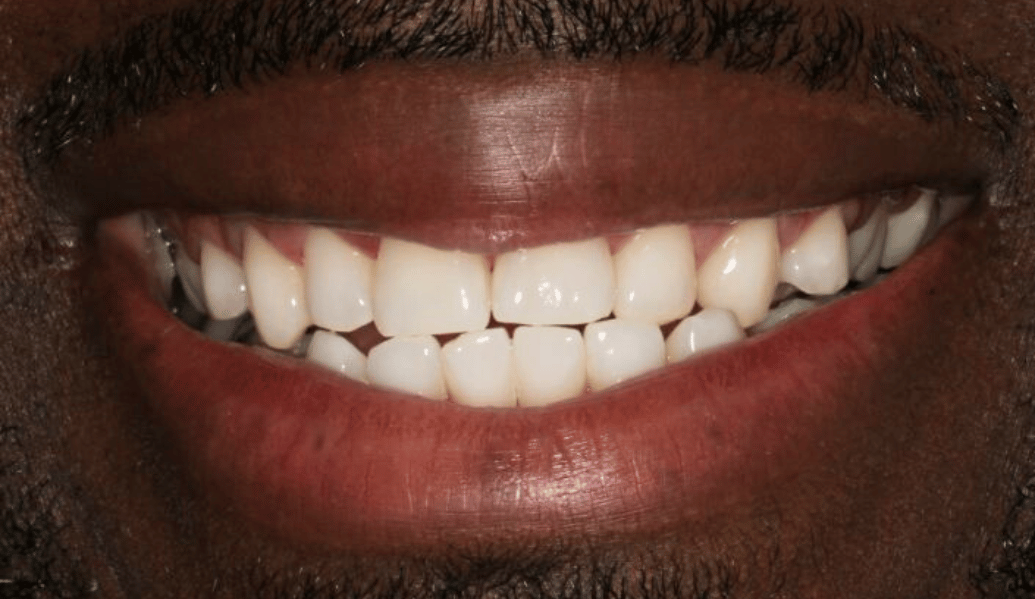 After - Fleckney Dental & Cosmetic Clinic