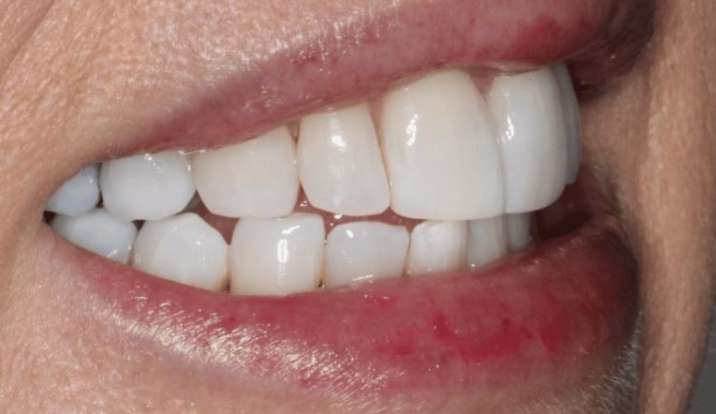 After - Fleckney Dental & Cosmetic Clinic